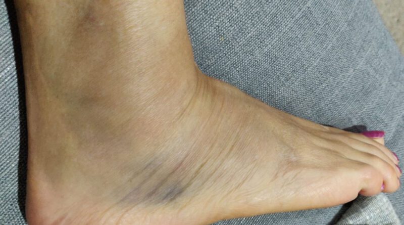 What are the types and levels of a sprained ankle?